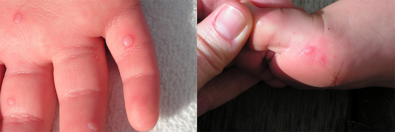 Blisters on store hands and feet